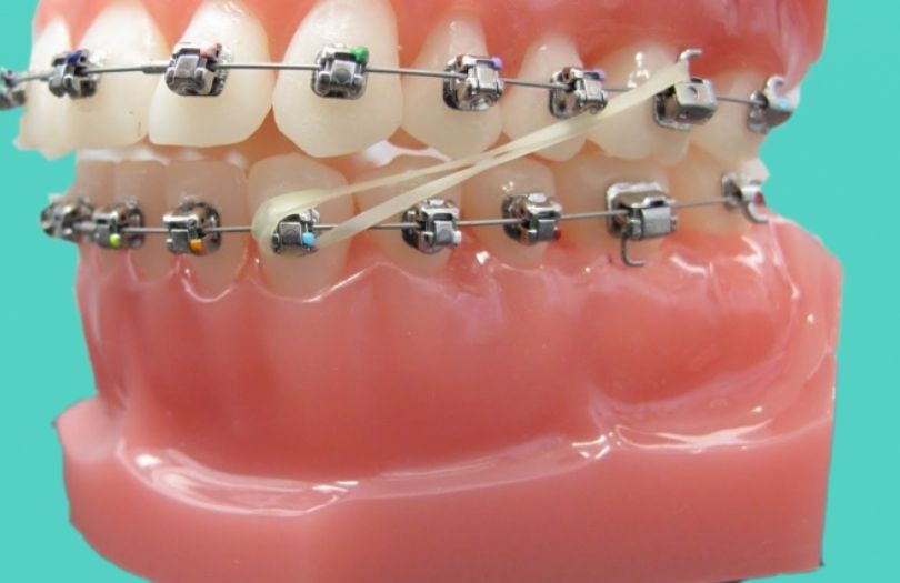 ortodontik Tedavilerde Elastik Kullanımı Ortodonti uzmanı özlem aylıkcı