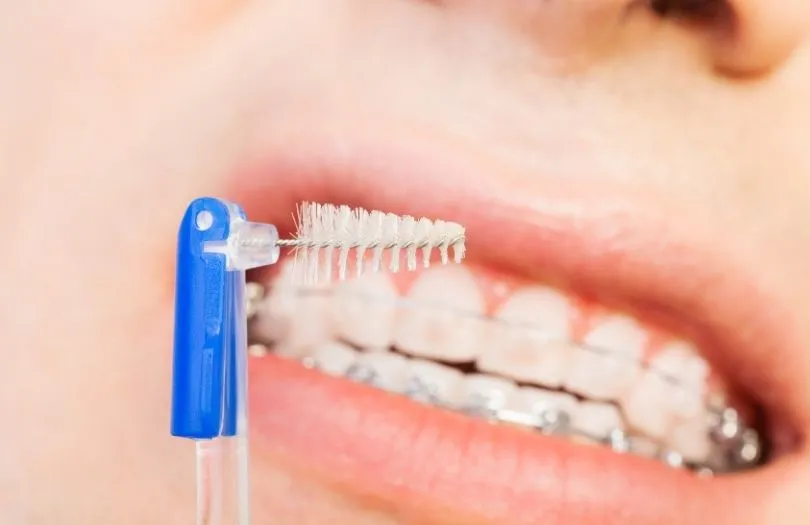 Braketlerinizle Iyi Gecinmenin Dort Sirri ara yuz fircasi agizda Dr ozlem aylikci ortodonti uzmani seffaf plak uzmani invisalign uzmani invisalign provider invisalign teen provider