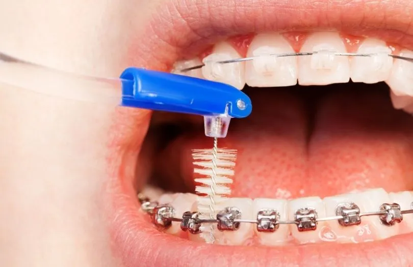 Braketlerinizle Iyi Gecinmenin Dort Sirri ara yuz fircasi uygulama Dr ozlem aylikci ortodonti uzmani seffaf plak uzmani invisalign uzmani invisalign provider invisalign teen provider