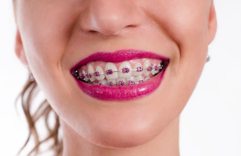 Braketlerle Guzel Fotograf Vermenin Sirlari nedir braket uzmani Dr ozlem aylikci ortodonti uzmani seffaf plak uzmani invisalign uzmani invisalign provider invisalign teen provider