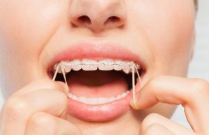 Ağız İçi Lastikleri Nasıl Kullanmalıyız?​ Dr. Özlem Aylıkcı Diş teli Uzmanı Şeffaf Plak Uzmanı