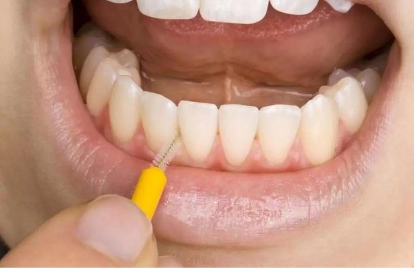 ara yuz fircasi kullanimi Dr Bahadir Ugur Aylikci lamine Uzmani Implant Uzmani Dis eti Uzmani Periodontoloji Uzmani Gulus Tasarimi Uzmani