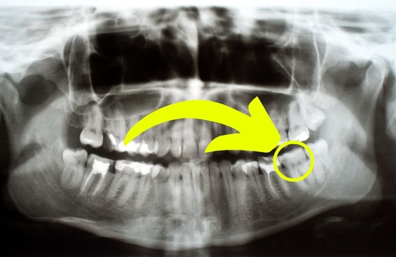 Dr ozlem aylikci ortodonti uzmani seffaf plak uzmani invisalign uzmani aktif curuk olan dis curuk baslangici