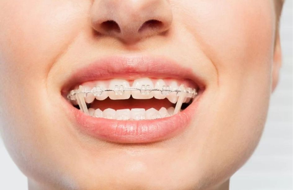 Dr ozlem aylikci ortodonti uzmani seffaf plak uzmani invisalign uzmani dis teline lastik nasil takilir ucgen lastik