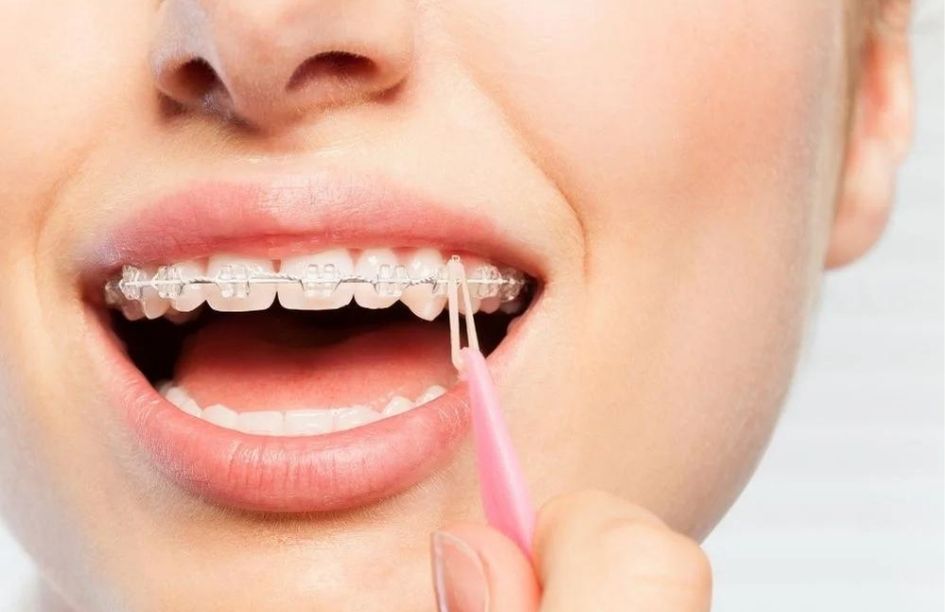 Dr ozlem aylikci ortodonti uzmani seffaf plak uzmani invisalign uzmani dis teline ucgen lastik takma lastik takma yontemleri