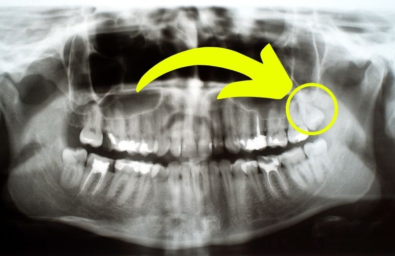 Dr ozlem aylikci ortodonti uzmani seffaf plak uzmani invisalign uzmani gomulu disler gomulu 20 yas disi