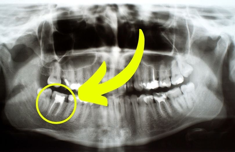 Dr ozlem aylikci ortodonti uzmani seffaf plak uzmani invisalign uzmani hatali kanal dolgusu