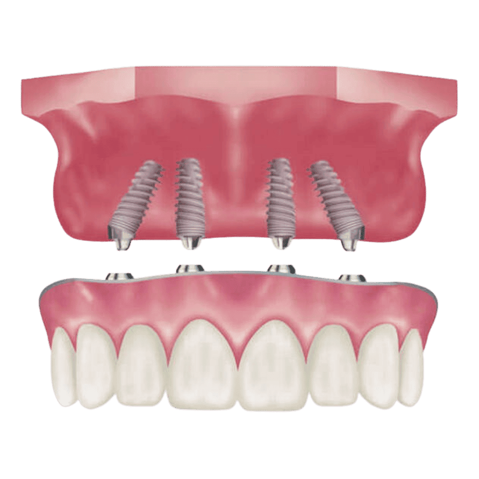 Uzman dr. Bahadir ugur aylikci all on four implant all on 4 implant