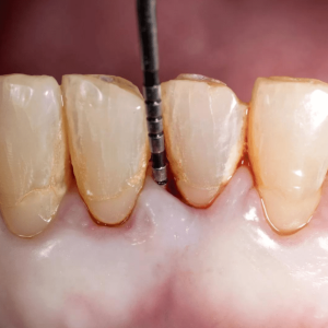 Uzman dr. Bahadir ugur aylikci periodontitis dis destek doku kaybi kemik erimesi