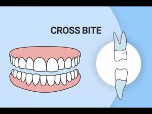 invisalign seffaf plaklarinin ku 2