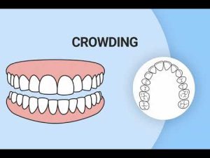 invisalign seffaf plaklarinin ku