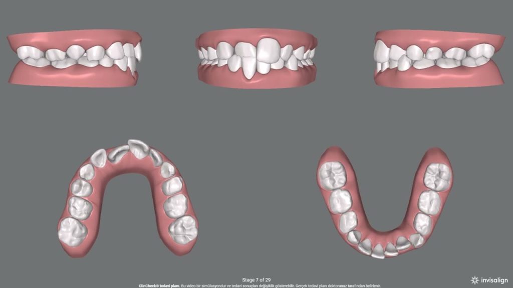 2 invisalign first cocuklarda in