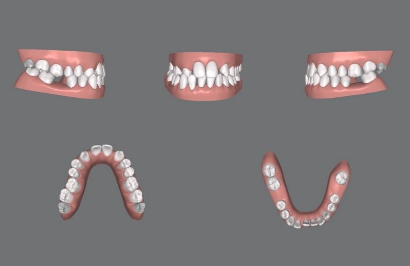 invisalign zor vaka paketi 30-40 plak drozlemorto