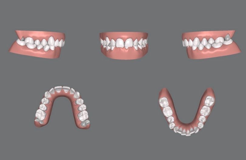 invisalign zor vaka paketi 40-50 plaklık vakalar Uzman Dr. Özlem Aylıkcı Drozlemorto