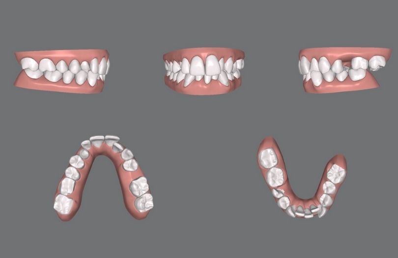 Invisalign Zor Vaka Paketi 50 Plak Üstü Vakalar