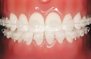3m clarity advance dr ozlem aylikci ortodonti uzmani seffaf braketler dis yuzeinde braket gorunmesin typodont