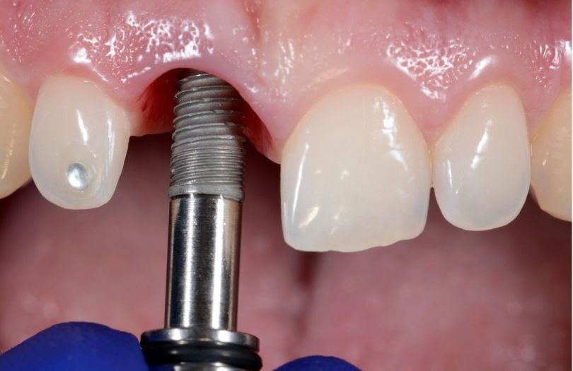 implant vakalari oncesi sonrasi Dental implant Vakaları Dentel İmplant vakaları Yabancı İmplantlar Vakaları öncesi sonrası istanbul implantoloji kliniği şşli nişantaşı dental implant dr. bahadır uğur aylıkcı yabancı implant markaları