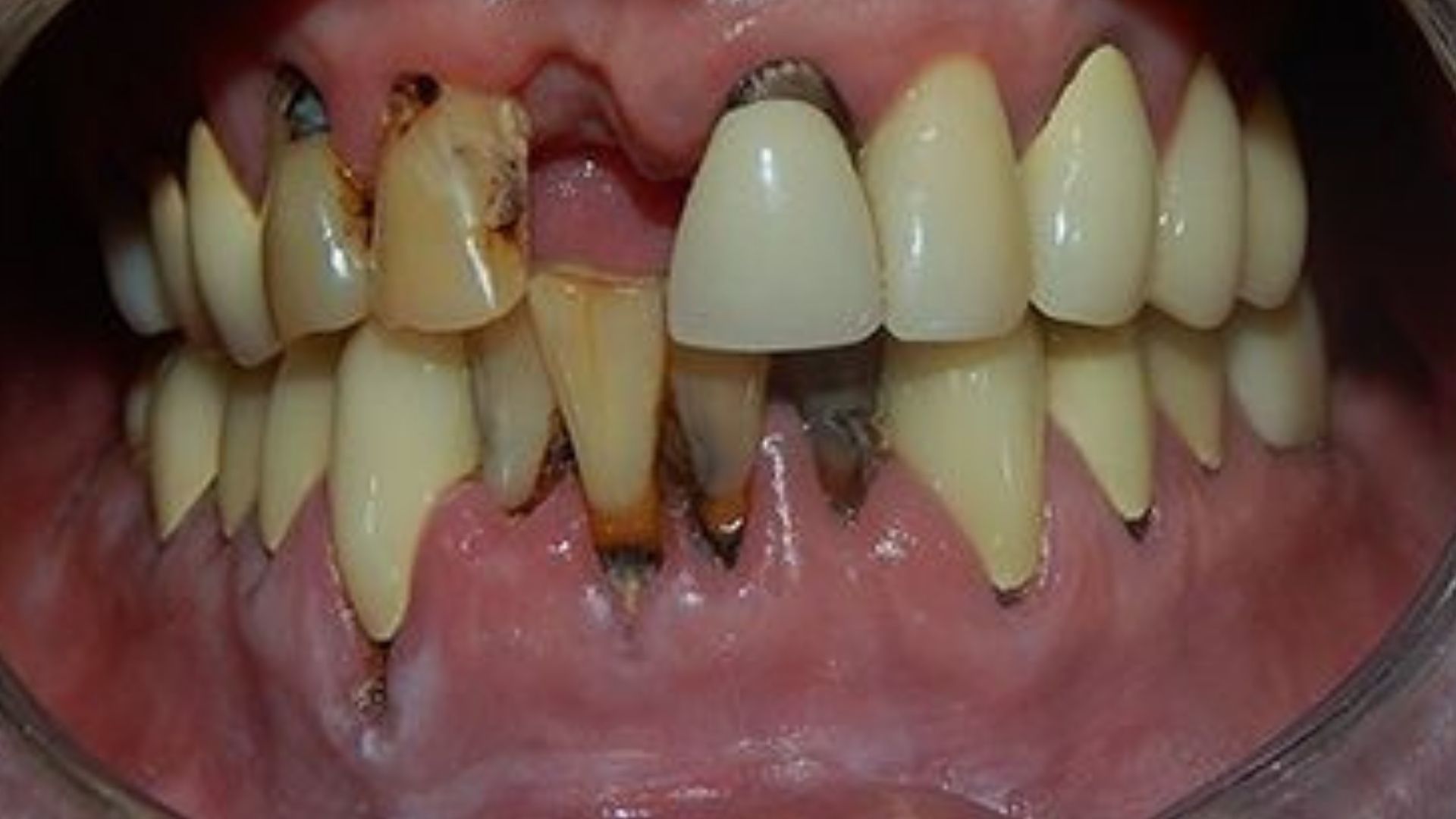 implant vakalari 1 Dr. Bahadir Ugur Aylikci Ortodonti Uzmani Dr. Ozlem Aylikci