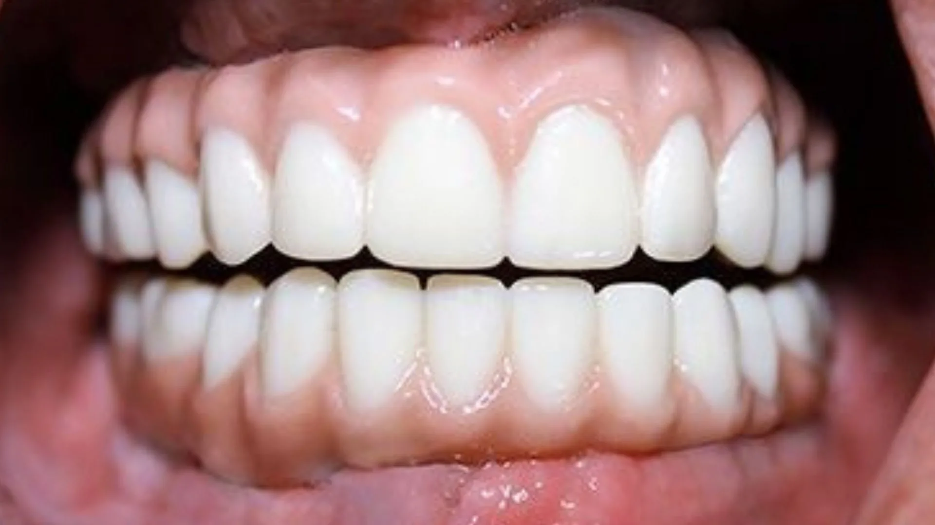 implant vakalari 2 Dr. Bahadir Ugur Aylikci Ortodonti Uzmani Dr. Ozlem Aylikci