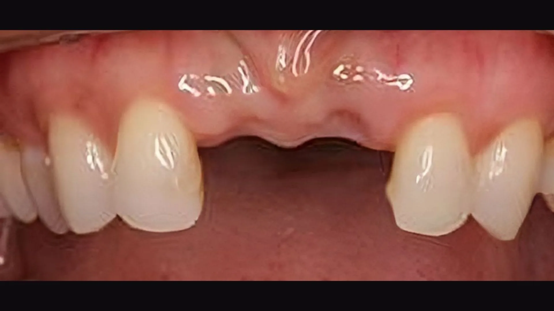 implant vakalari 5 Dr. Bahadir Ugur Aylikci Ortodonti Uzmani Dr. Ozlem Aylikci