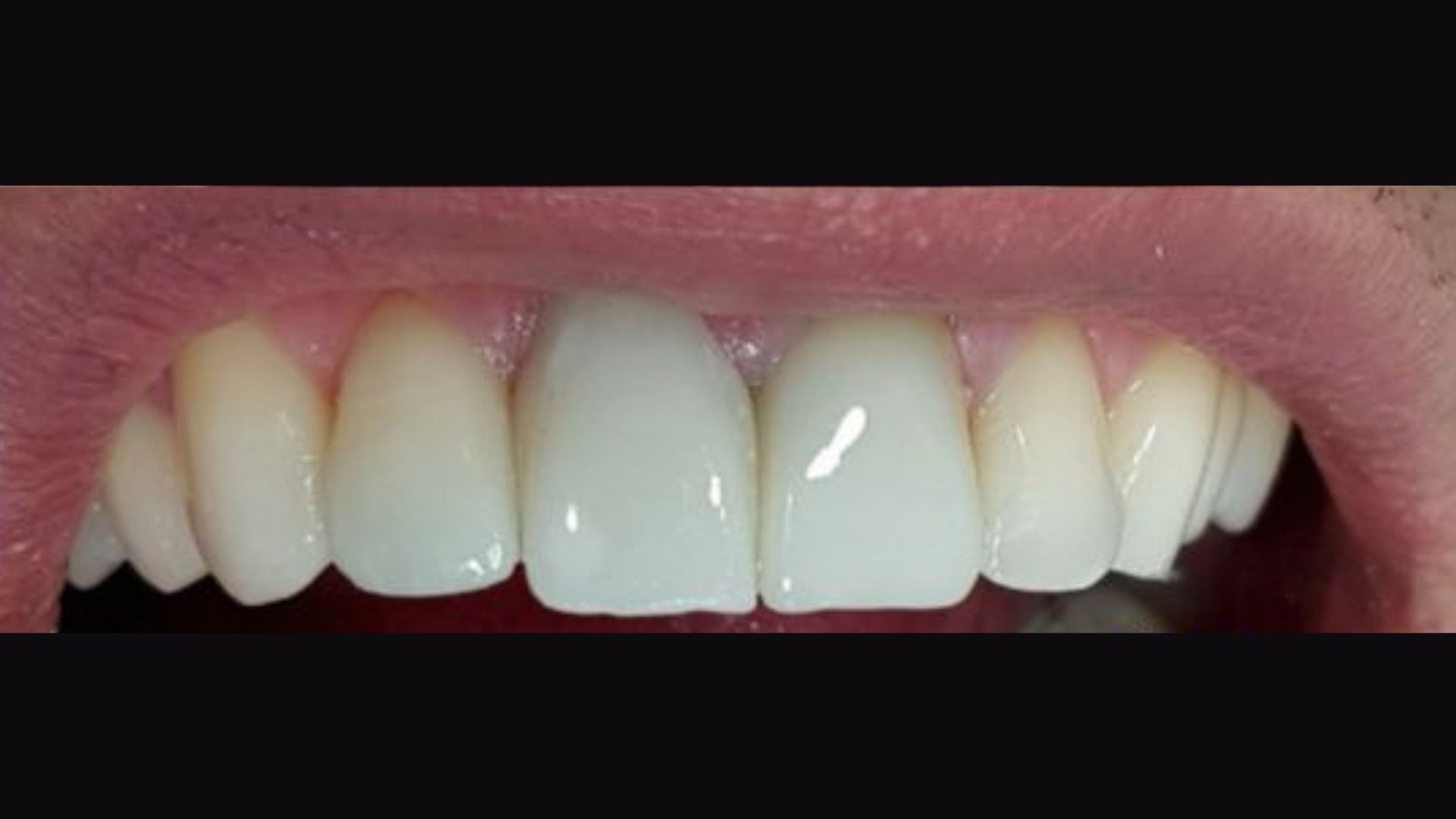 implant vakalari 8 Dr. Bahadir Ugur Aylikci Ortodonti Uzmani Dr. Ozlem Aylikci