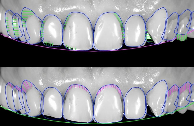 Dijital Smile Design Gulus Tasarimi Dr Bahadir Ugur Aylikci Implant Uzmani Dis eti Uzmani Periodontoloji Uzmani Gulus Tasarimi Uzmani