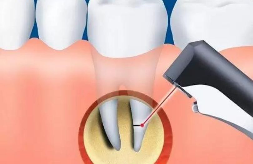 Dental Apikal Rezeksiyon dr bahadır uğur aylıkcı