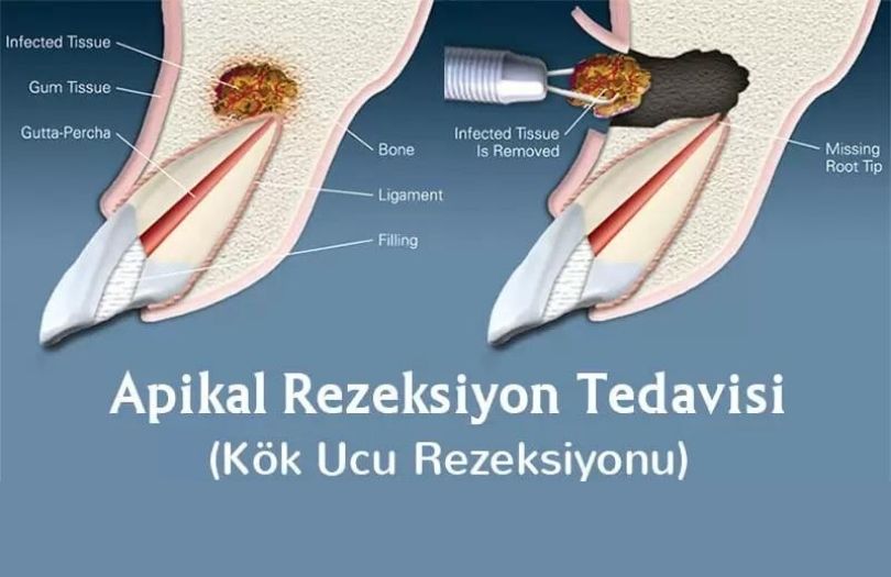 Dr. Ozlem Aylikci Drozlemorto Gulus Tasarim Uzmani dr. Bahadir Ugur Aylikci Apikal Rezeksiyon nasil yapilir