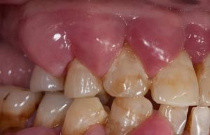 Dr. Ozlem Aylikci Drozlemorto Gulus Tasarim Uzmani dr. Bahadir Ugur Aylikci Dis Eti Buyumesi Gingival Enlargment