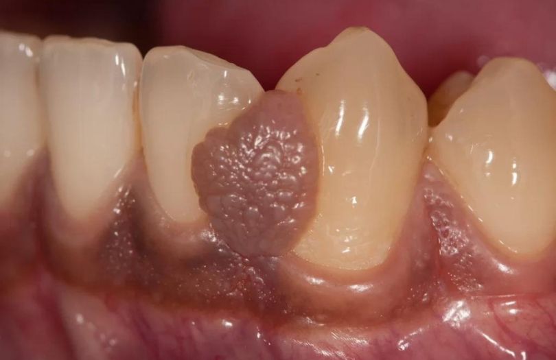 diş eti büyümesi diş eti fazlalığı uzman dr. bahadır uğur aylıkcı periodontoloji drozlemorto