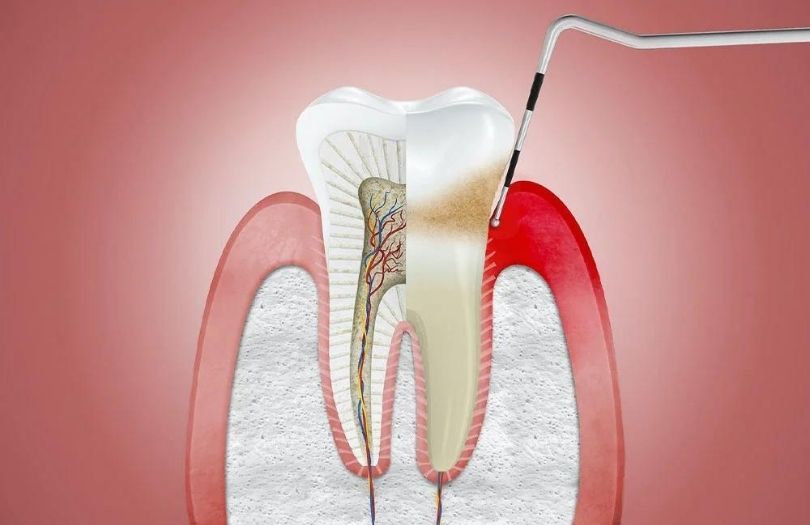 Dr. Ozlem Aylikci Drozlemorto Gulus Tasarim Uzmani dr. Bahadir Ugur Aylikci Gingivitis Probing