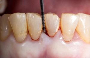 Periodontitis – Diş Destek Kemik Doku Kaybı dr. bahadır uğur aylıkcı şişli diş klinigi uzman doktor diş eti uzmanı Periodontoloji – Diş Eti Tedavisi​