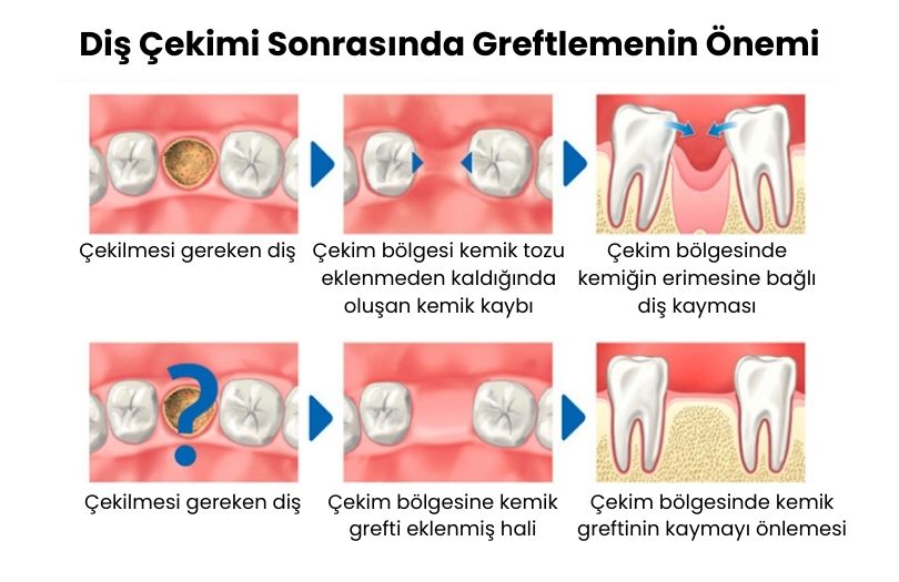 Dr. Ozlem Aylikci Drozlemorto Gulus Tasarim Uzmani dr. Bahadir Ugur Aylikci alveolar kemik grefti cekim boslupunu greftlemenin onemi