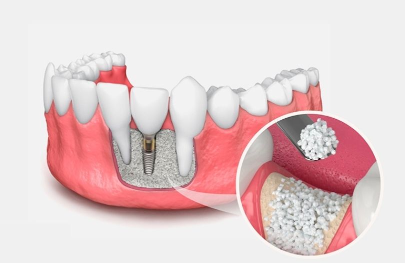 Dr. Ozlem Aylikci Drozlemorto Gulus Tasarim Uzmani dr. Bahadir Ugur Aylikci alveolar kemik grefti implant cevresi