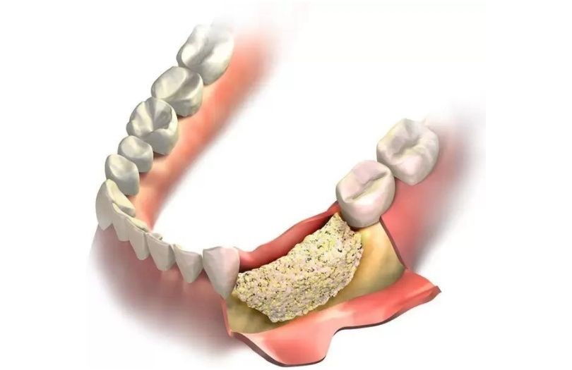 Alveoler Kemik Augmentasyonu