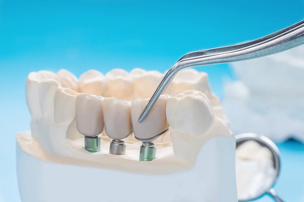 Dr. Özlem Aylıkcı Dental Klinik Ağız ve Çene Cerrahisi işlemleri nelerdir. dental implant kemik grefti