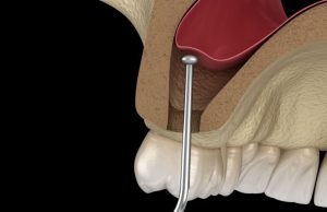 Dr. Ozlem Aylikci Drozlemorto Gulus Tasarim Uzmani dr. Bahadir Ugur Aylikci implanta Hazirlik sinus lifting sinus zarini kaldirma