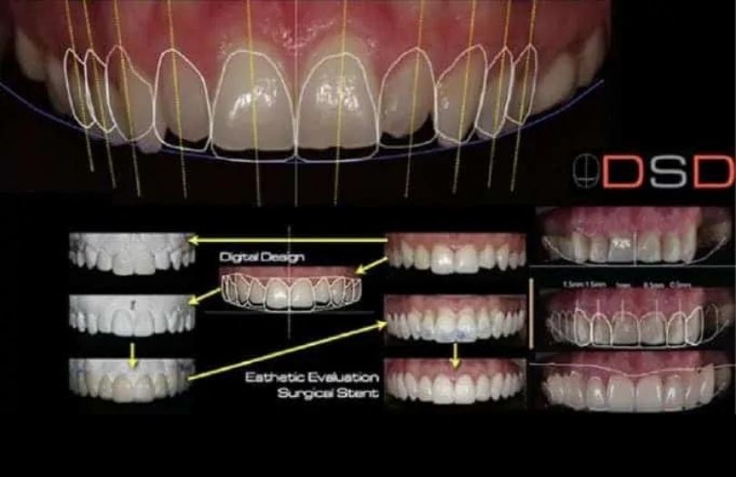 Gulus Tasarimi DSD Dr Bahadir Ugur Aylikci Implant Uzmani Dis eti Uzmani Periodontoloji Uzmani Gulus Tasarimi Uzmani