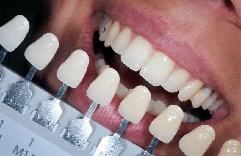 Laminate Veneer renk secimi Dr Bahadir Ugur Aylikci lamine Uzmani Implant Uzmani Dis eti Uzmani Periodontoloji Uzmani Gulus Tasarimi Uzmani