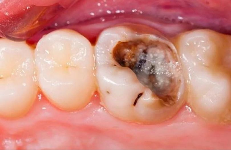 azi disi curugu Dr Bahadir Ugur Aylikci lamine Uzmani Implant Uzmani Dis eti Uzmani Periodontoloji Uzmani Gulus Tasarimi Uzmani