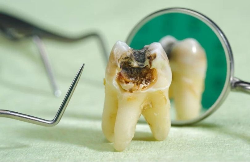 curuk azi disi Dr Bahadir Ugur Aylikci lamine Uzmani Implant Uzmani Dis eti Uzmani Periodontoloji Uzmani Gulus Tasarimi Uzmani