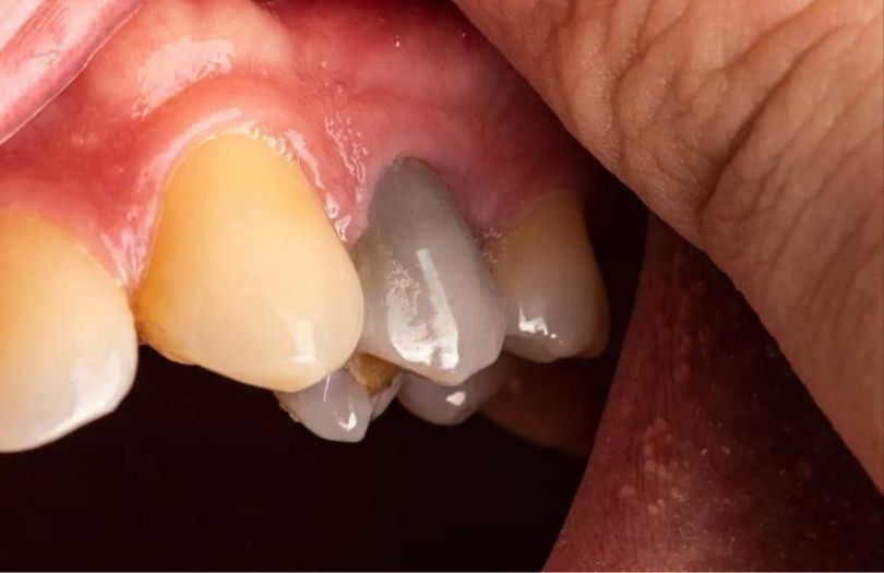 curuk premolar Dr Bahadir Ugur Aylikci lamine Uzmani Implant Uzmani Dis eti Uzmani Periodontoloji Uzmani Gulus Tasarimi Uzmani