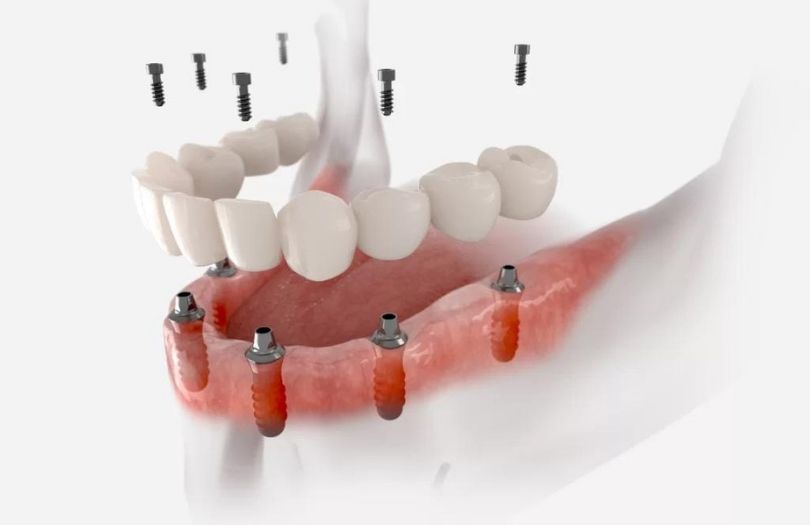 implant ustu protez Dr Bahadir Ugur Aylikci lamine Uzmani Implant Uzmani Dis eti Uzmani Periodontoloji Uzmani Gulus Tasarimi Uzmani