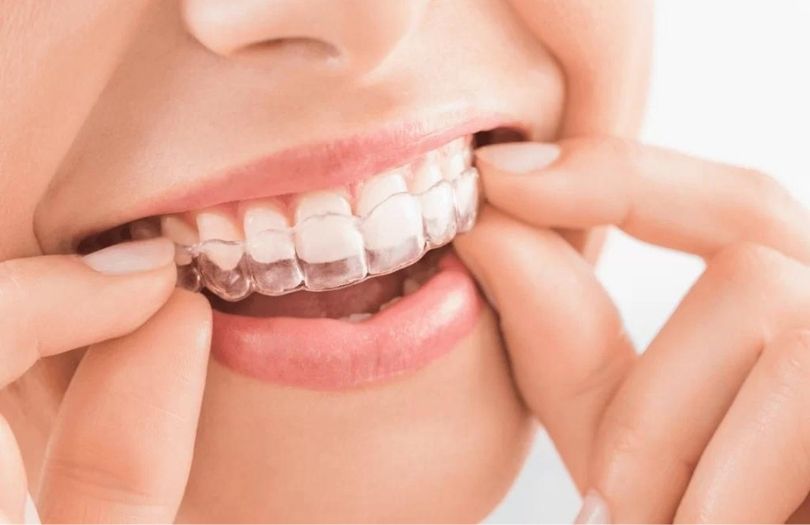 Ortodontik tedaviler uzman doktor özlem aylıkcı şeffaf plak uzmanı Invisalign ve diş teli: Kapsamlı bir kılavuz