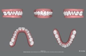 Invisalign Basit Vaka Paketi Hastaları
