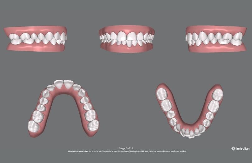 Invisalign Basit Vaka Paketi Hastaları