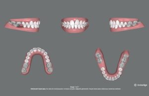 7 plak express Drozlemorto Dr Ozlem Aylikci dis teli seffaf plak invisalign orthero lingual tel sakli tel invisalign teen implant gulus tasarimi diseti uzmani