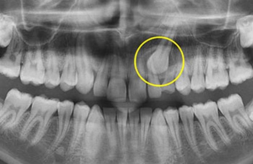 ortodonti uzmani dr. ozlem aylikci gomulu kanin disi seffaf plak uzmani invisalign first